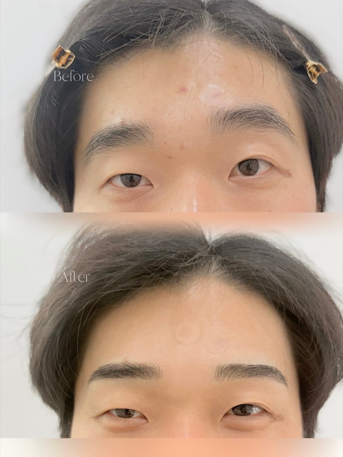 남자눈썹 시술 전후 사진